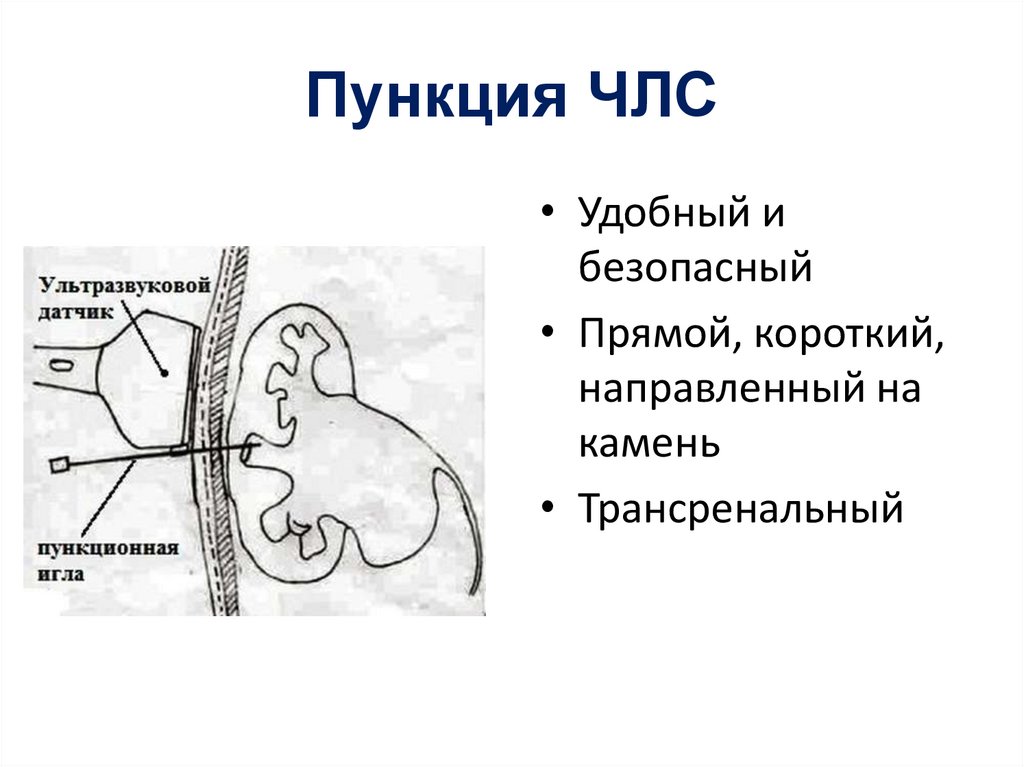 Перкутанная нефролитотрипсия - online presentation