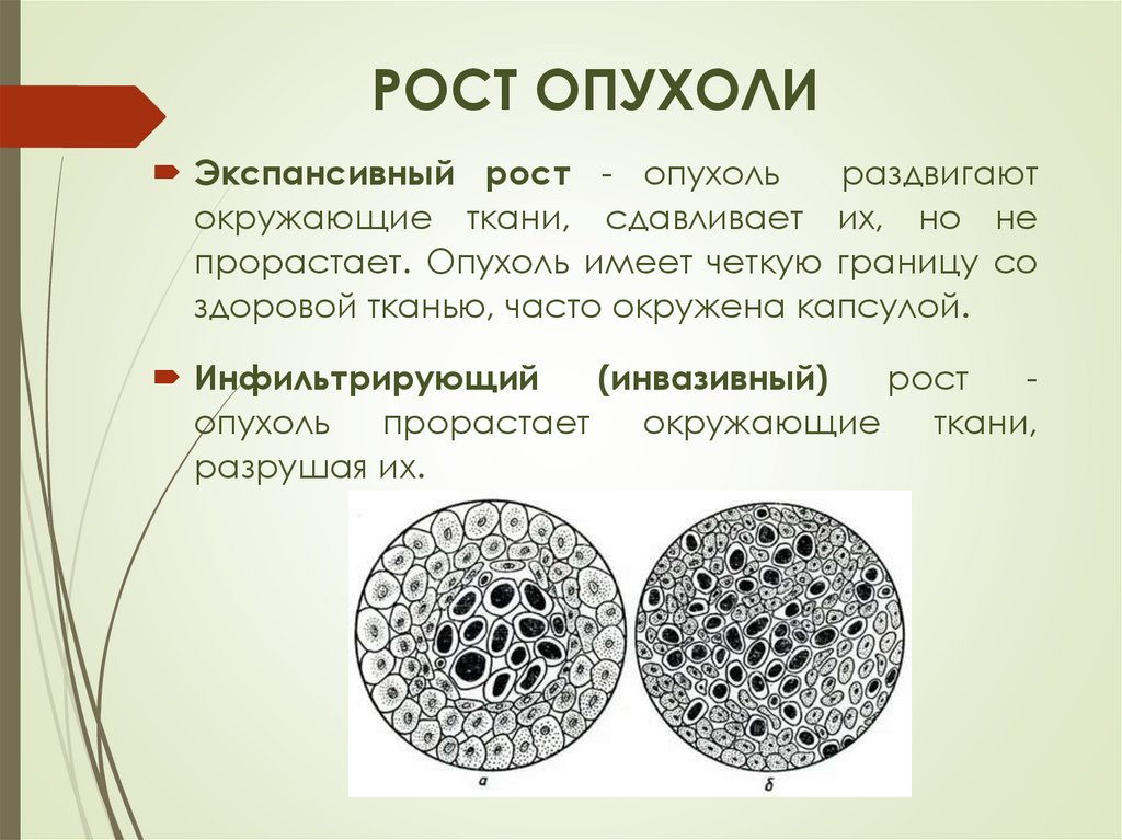 Подпишите картинки виды опухолевого роста