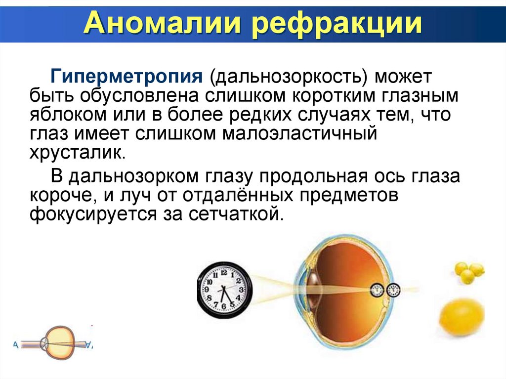 Аномалии клинической рефракции