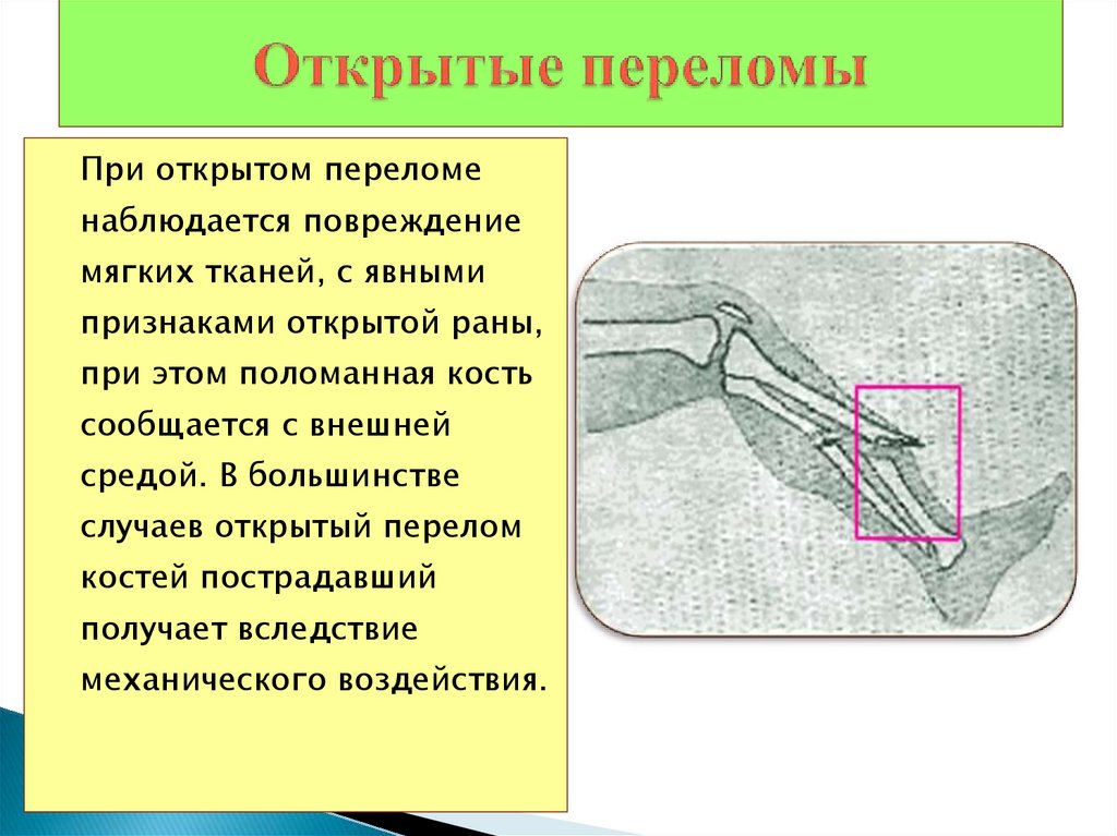 Перелом ребер мкб