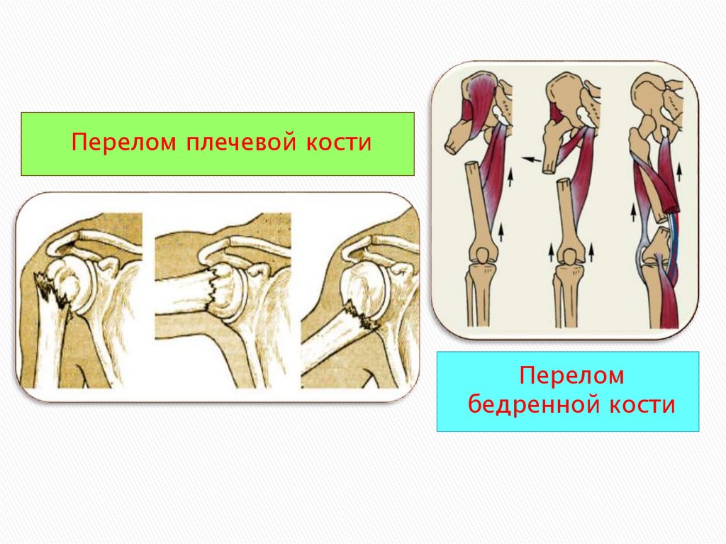 Закрытый перелом плечевой кости. Перелом плечевой кости. Перелом плечевой и бедренной кости. Переломы плечевой кости презентация. Переломы бедренной кости презентация.