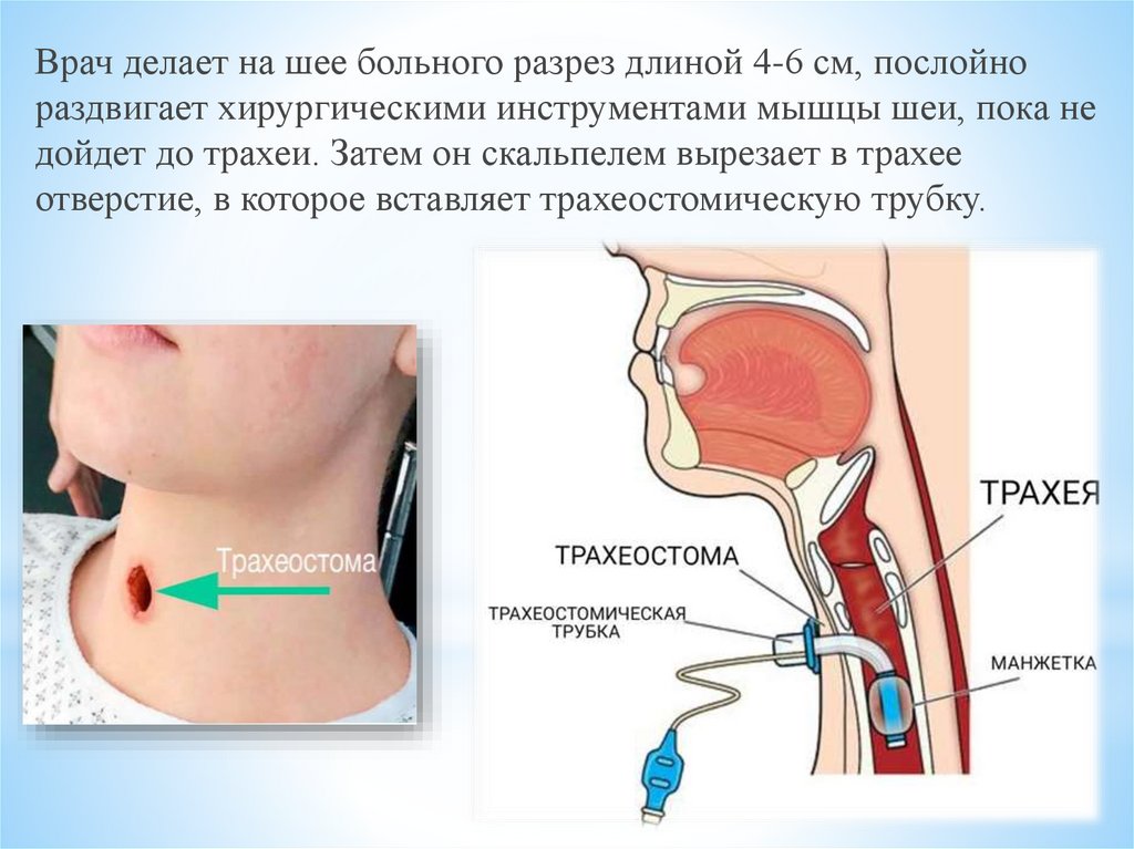 Трахеостома показания