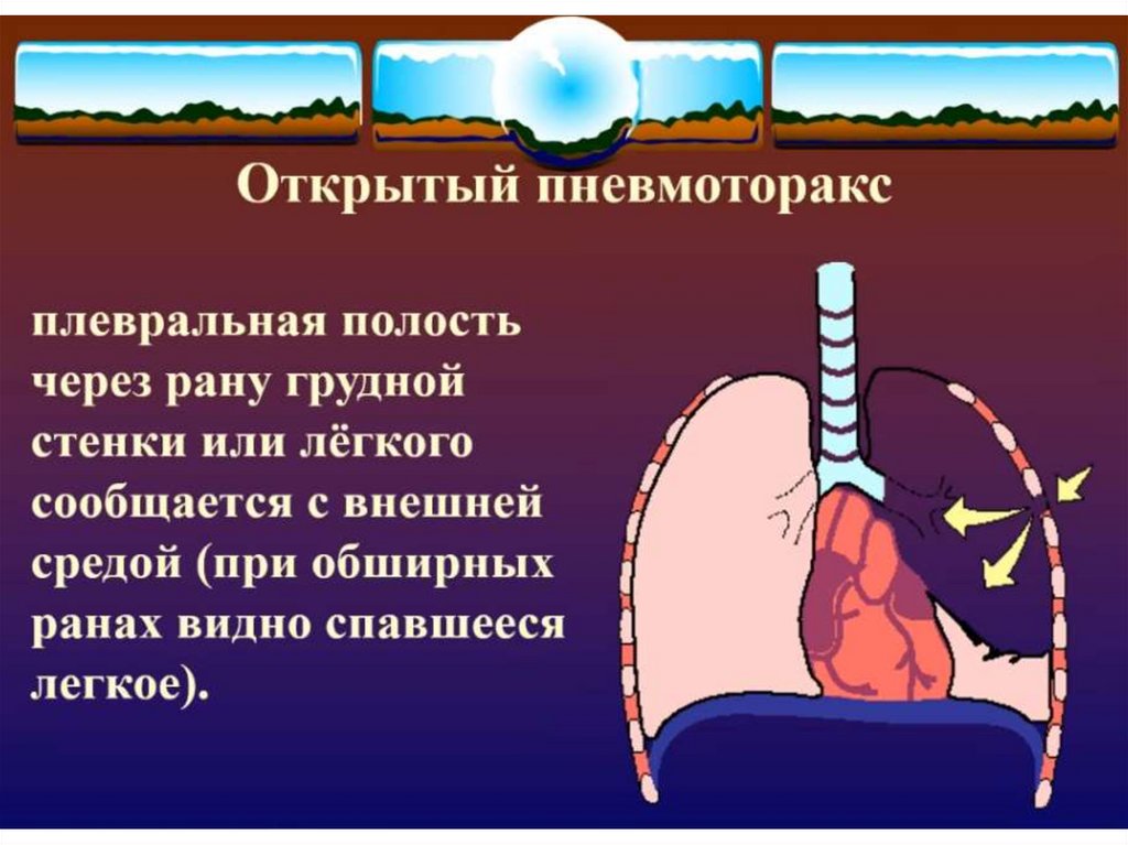 Ранения грудной полости. Открытый пневмоторакс. Открытыйпневмотораксе. Наружный открытый пневмоторакс.