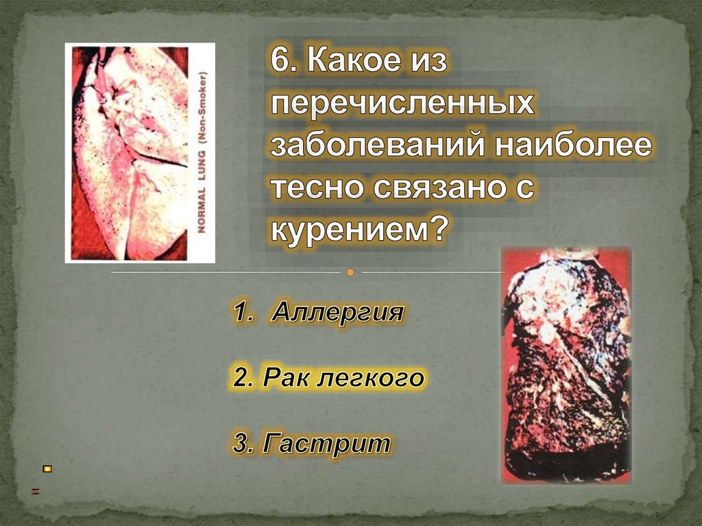 6. Какое из перечисленных заболеваний наиболее тесно связано с курением?