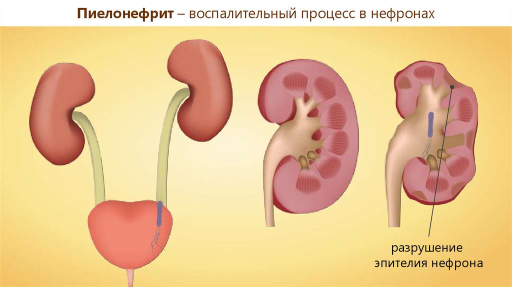 Болезням 38. Заболевания органов мочевыделения. Заболевания органов мочевыделения 8 класс. Заболевание органов мочевыделения проект. 38 Заболевания органов мочевыделения 8 класс.