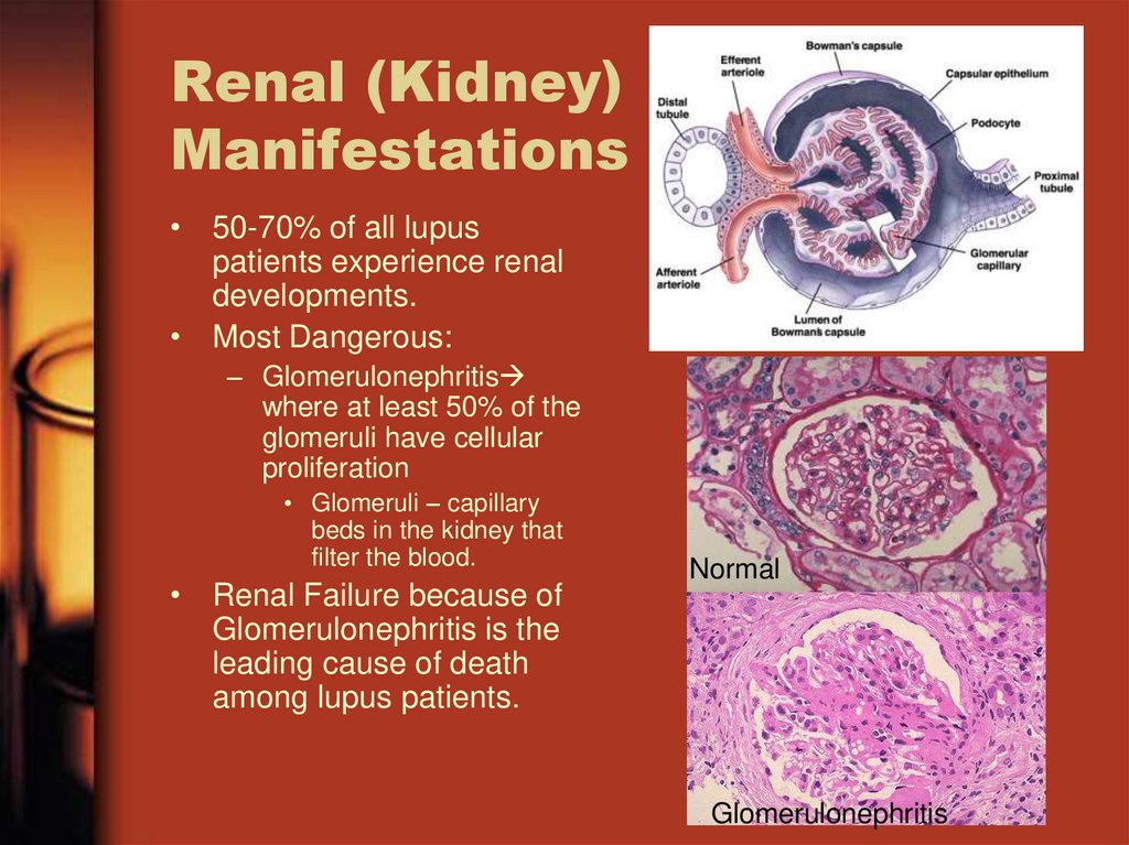 Renal (Kidney) Manifestations