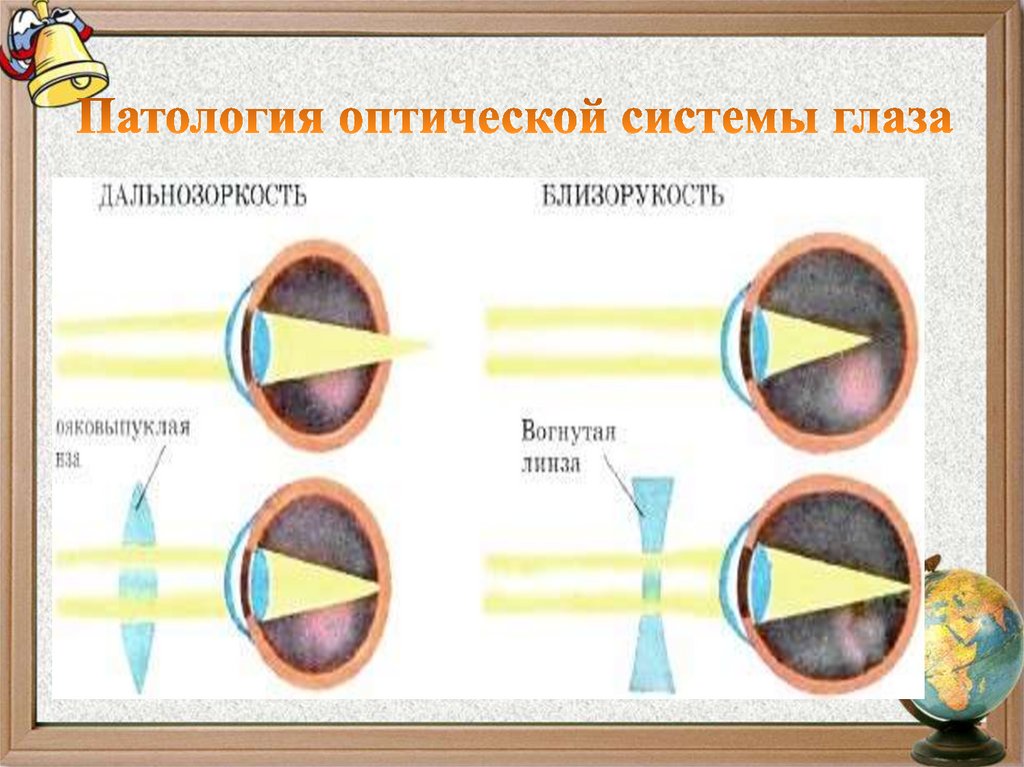 Патология оптической системы глаза