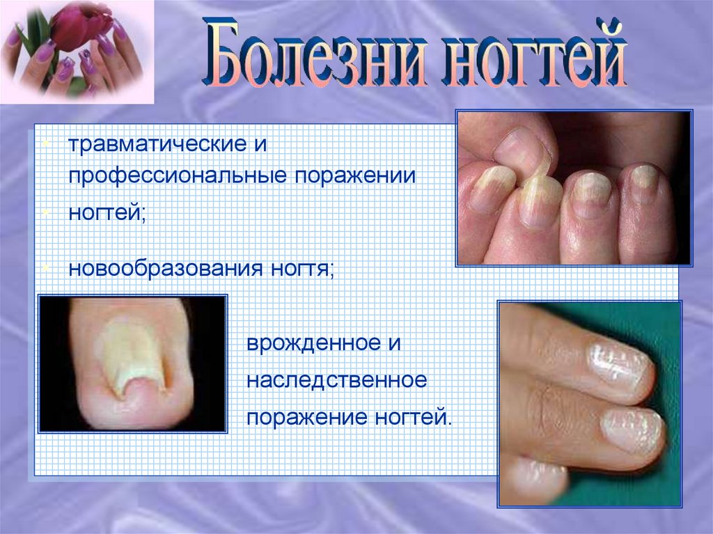 О чем говорит заболевание ногтей. Заболевания ногтя и ногтевого ложа.