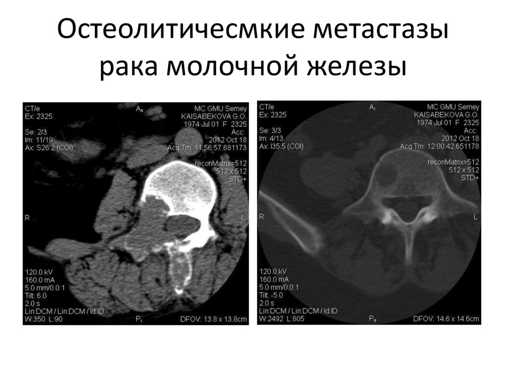 Остеолитичесмкие метастазы рака молочной железы