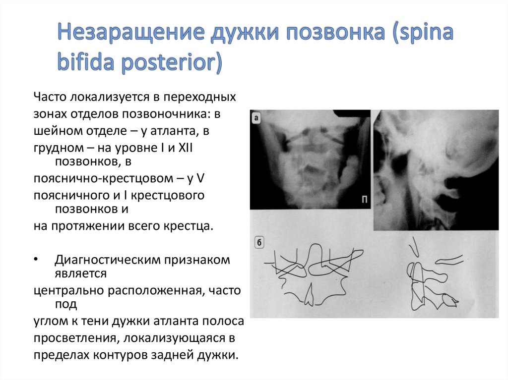 Незаращение дужки позвонка (spina bifida posterior)