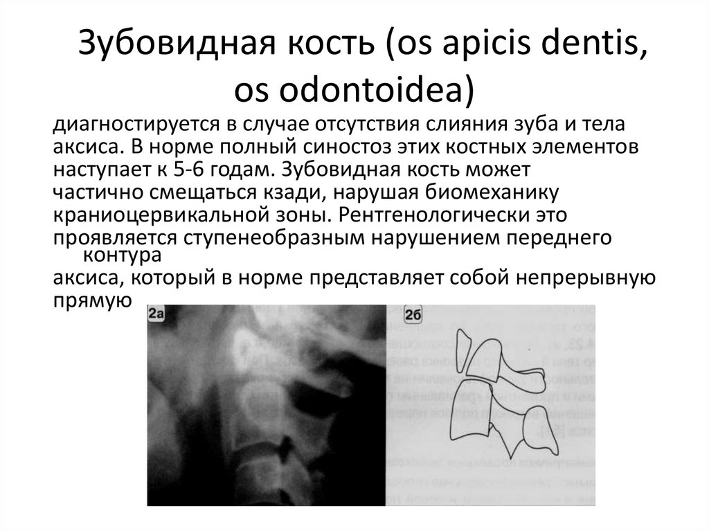 Зубовидная кость (os apicis dentis, os odontoidea)