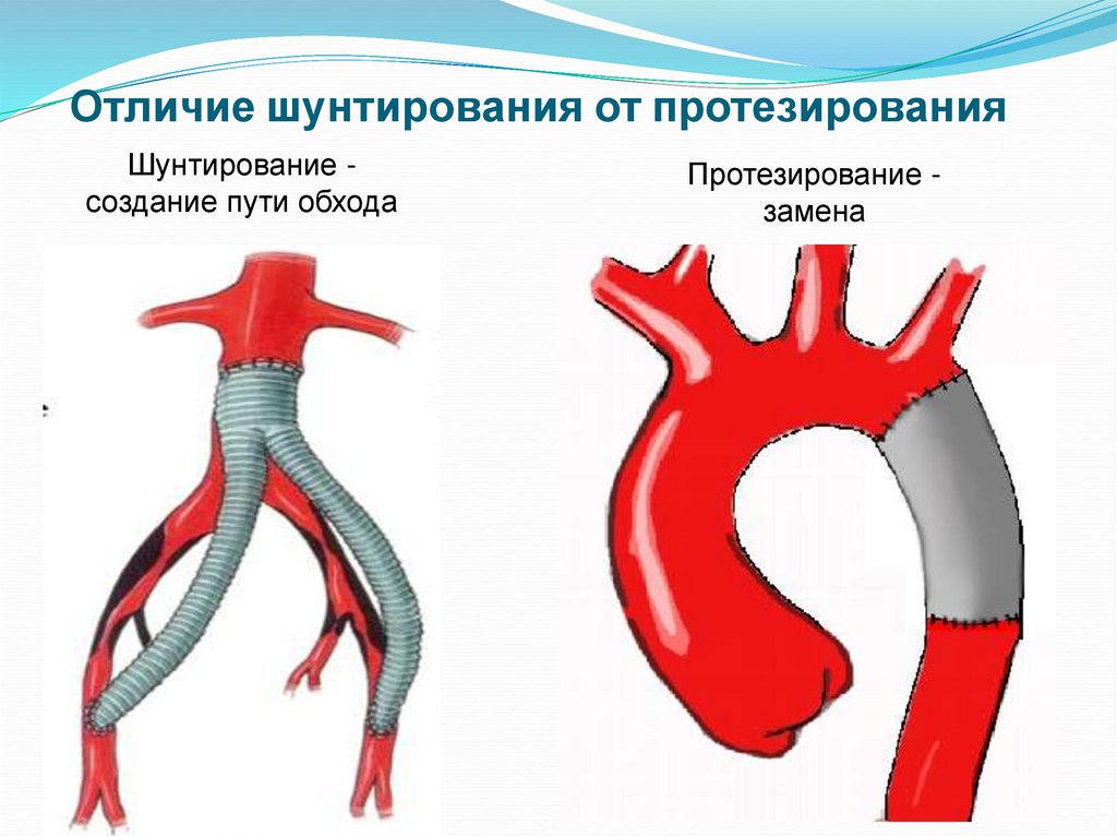 Что такое шунтирование