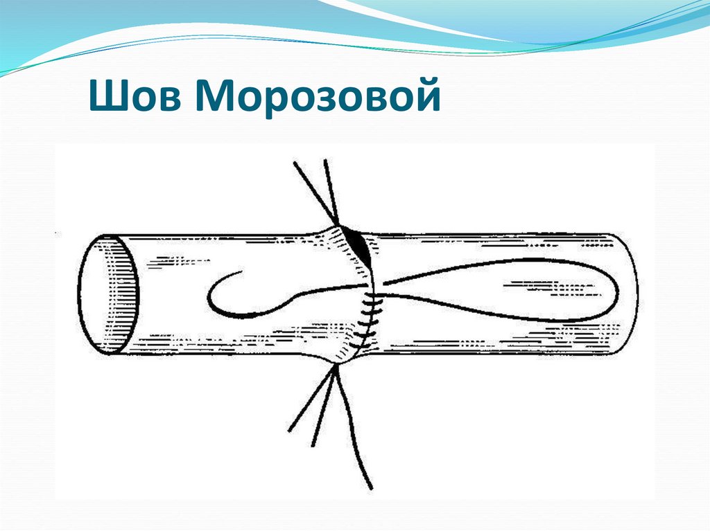 Сосудистый шов - online presentation