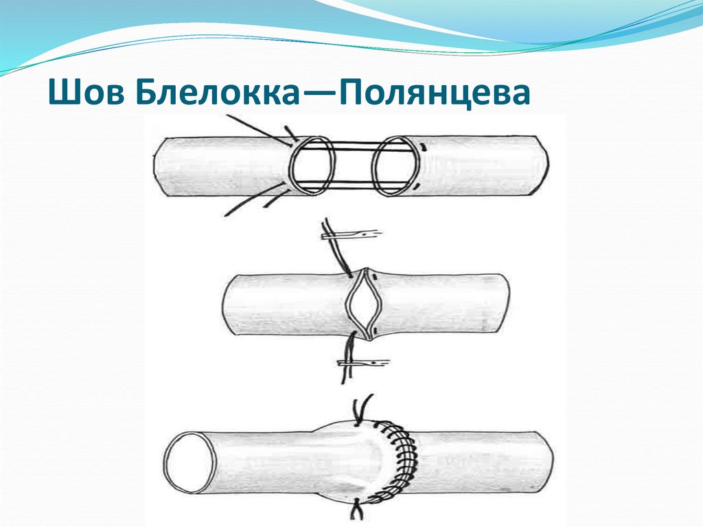 Шов Блелокка—Полянцева