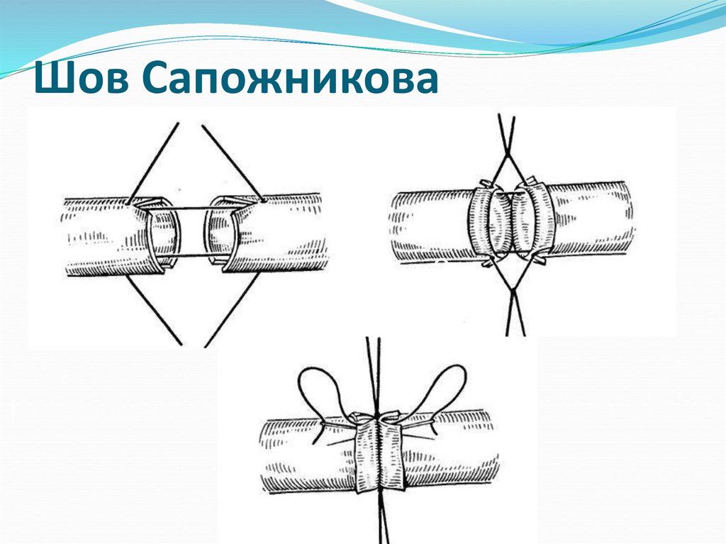 Сосудистый шов история