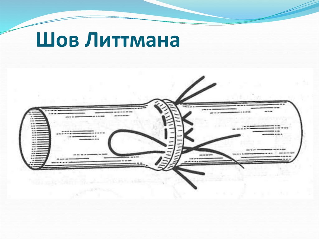 Шов Литтмана