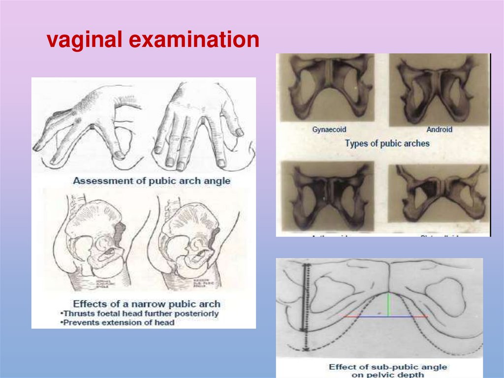 Abnormalities Of Bony Pelvis презентация онлайн