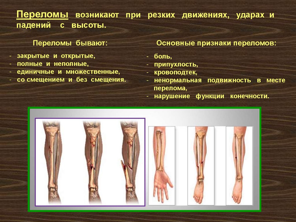 Абсолютные переломы. Типы переломов костей конечностей. Переломы костей и их признаки. Классификация закрытых переломов.