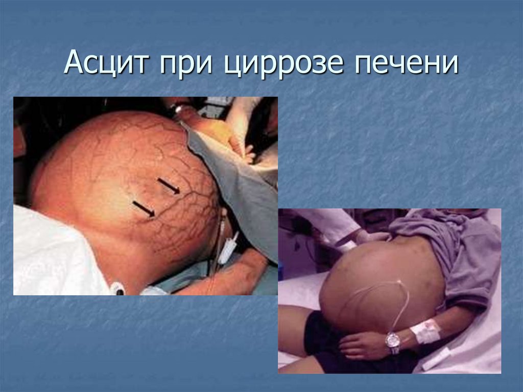 Асцит при циррозе печени
