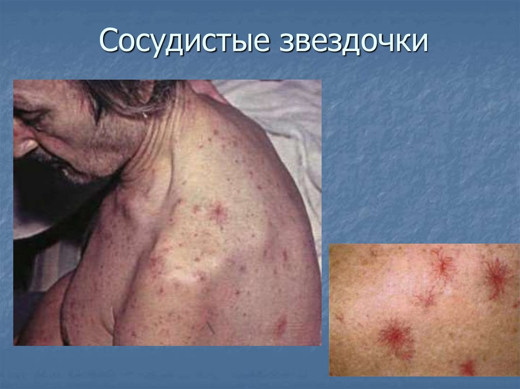 Сосудистые звездочки