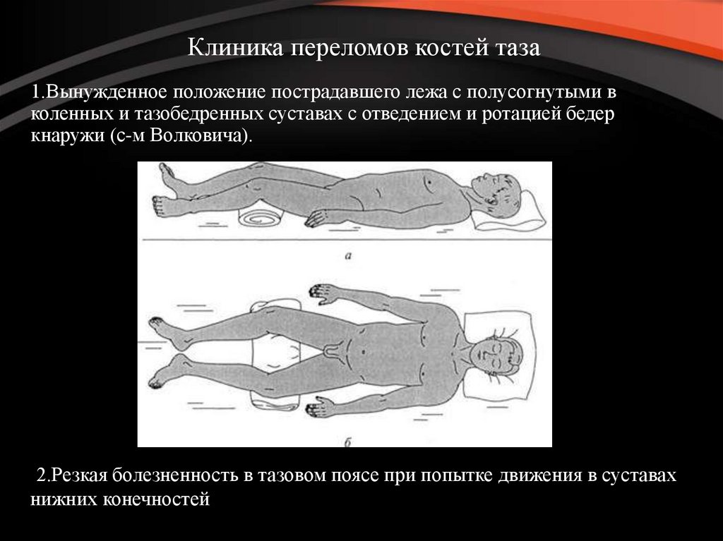 Перелом таза симптомы. Перелом костей таза клиника. Краевые переломы костей таза. Положение при переломе таза.