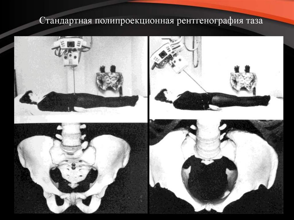 Переломы костей таза презентация