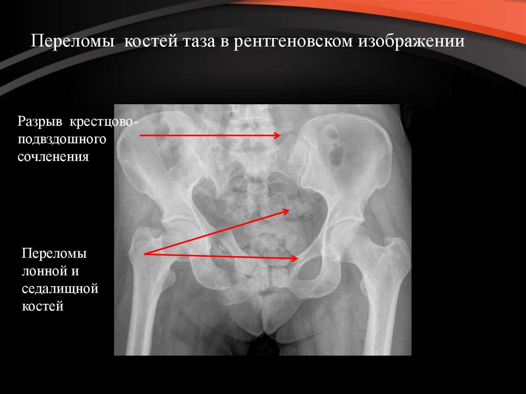 Разрыв крестцов. Перелом седалищной и лонной кости рентген. Перелом лобковой кости таза рентген. Перелом крестца и лонной кости. Перелом нижней ветви левой лонной кости.