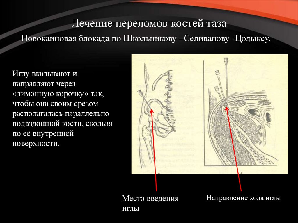 Как лечить трещину кости. Блокада тазовых нервных стволов по Школьникову-Селиванову. Блокада по Школьникову-Селиванову техника. Внутритазовая блокада по Школьникову-Селиванову. Блокада по Школьникову-Селиванову Цодыксу.