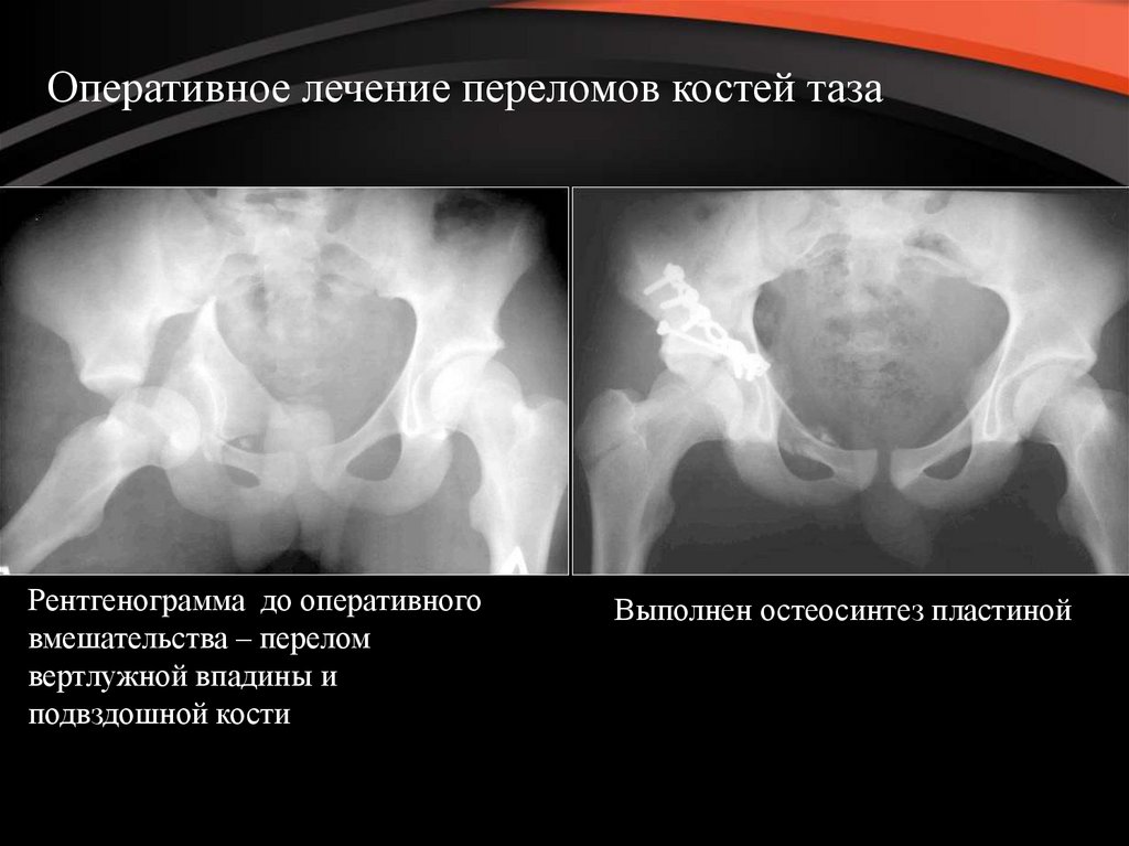 Переломы таза у детей презентация