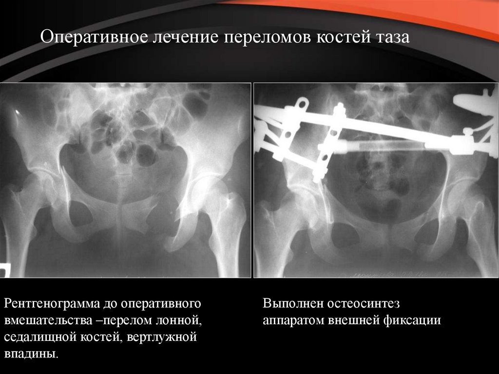 Оперативное лечение перелома костей