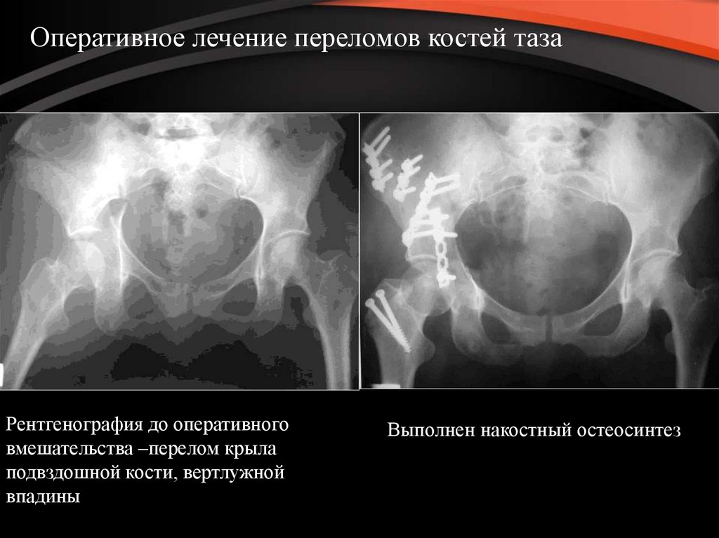 Перелом костей таза. Перелом таза остеосинтез рентген. Накостный остеосинтез костей таза. Накостный остеосинтез костей таза рентген. Перелом подвздошной кости.