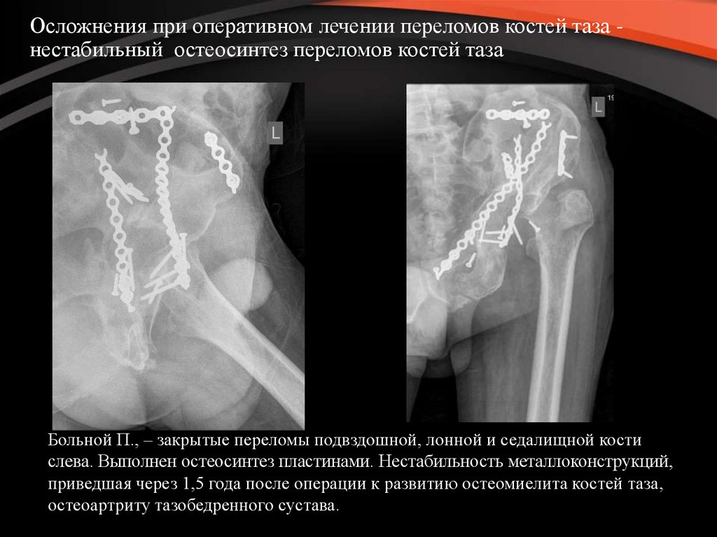 Возможное осложнение перелома. Перелом седалищной кости рентген. Перелом подвздошной рентген. Перелом таза остеосинтез.