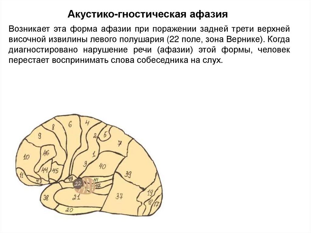 Эфферентная афазия