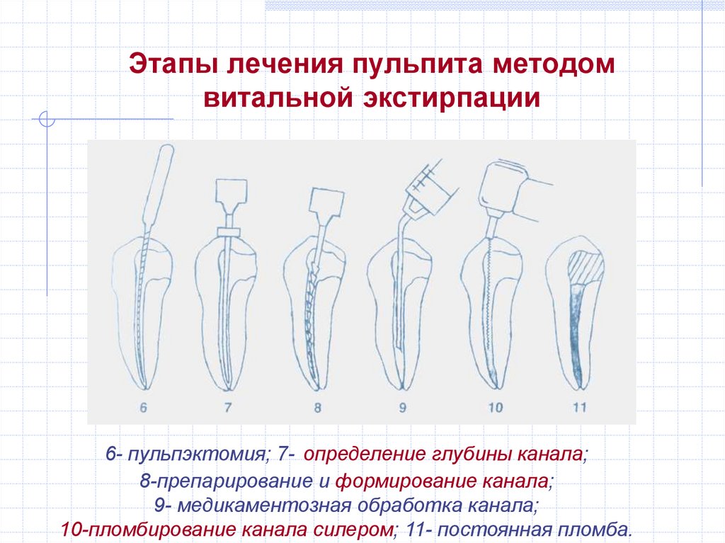 Методы лечения пульпита