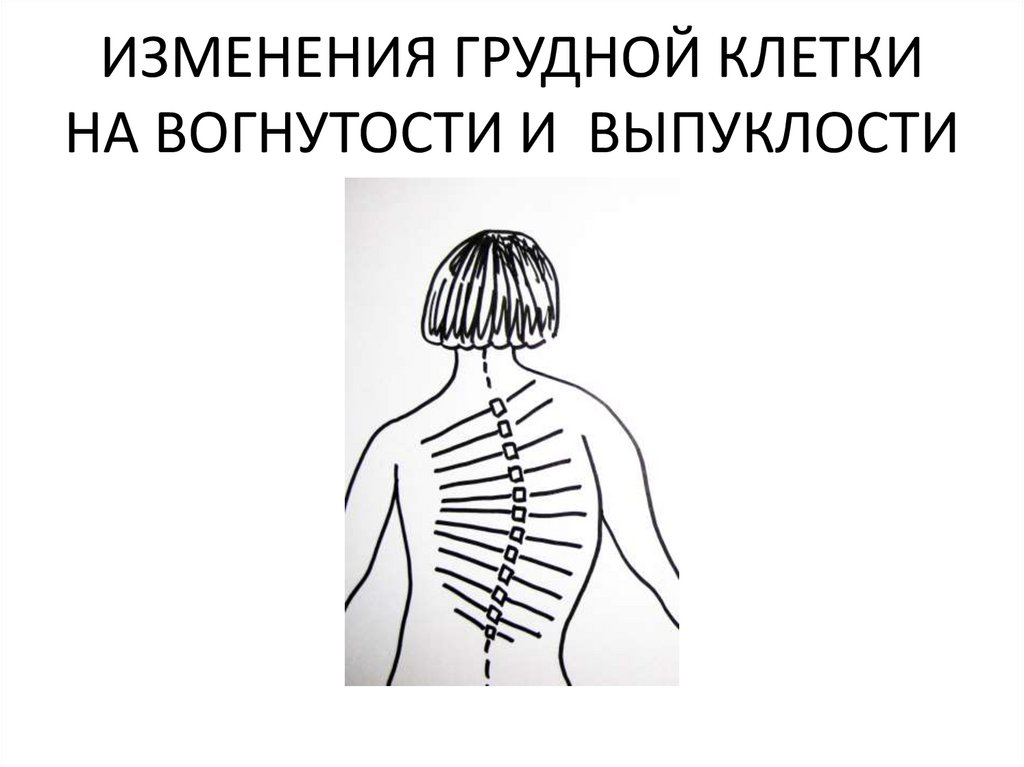 Изменения грудной. Массаж грудной клетки при сколиозе. Изменение грудной клетки. Сколиоз гипертонус мышц. Изменения в грудной клетке при сколиозе.