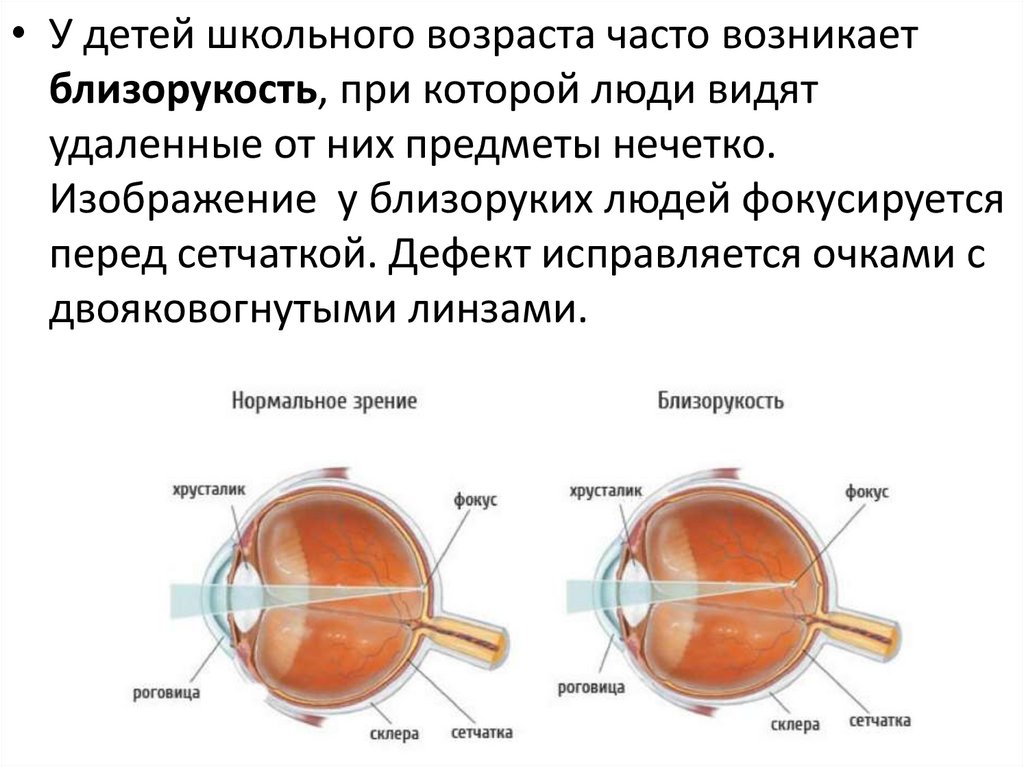 Заболевания глаз биология 8 класс