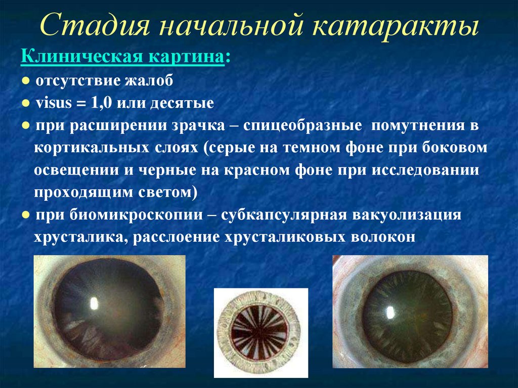 Зрачок в организме человека выполняет функцию. Спицеобразная катаракта. Переднекапсулярная катаракта. Катаракта на щелевой лампе. Причины развития катаракты.