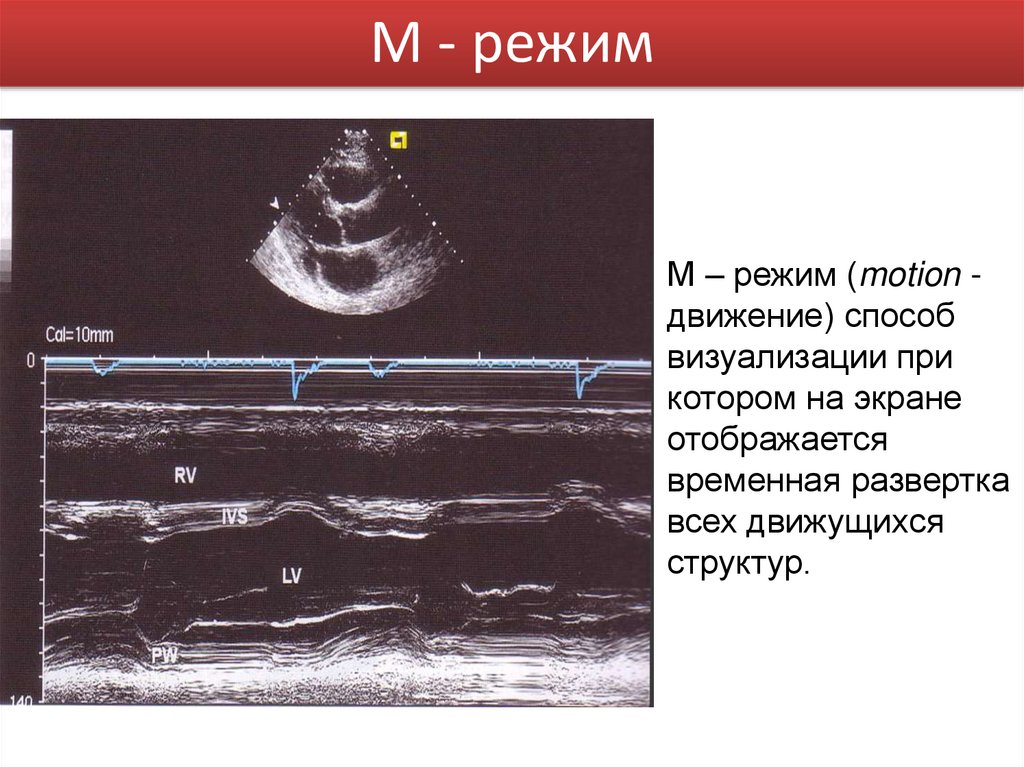 М режим. М режим используется для. Б режим ультразвукового исследования. М-режим УЗИ применяется для исследования:.