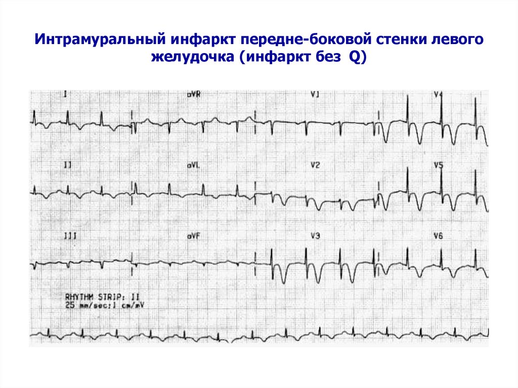 Изменение передней стенки левого желудочка. Мелкоочаговый инфаркт передней стенки. Мелкоочаговый инфаркт на ЭКГ. Крупноочаговый и мелкоочаговый инфаркт миокарда на ЭКГ. Мелкоочаговый им на ЭКГ.