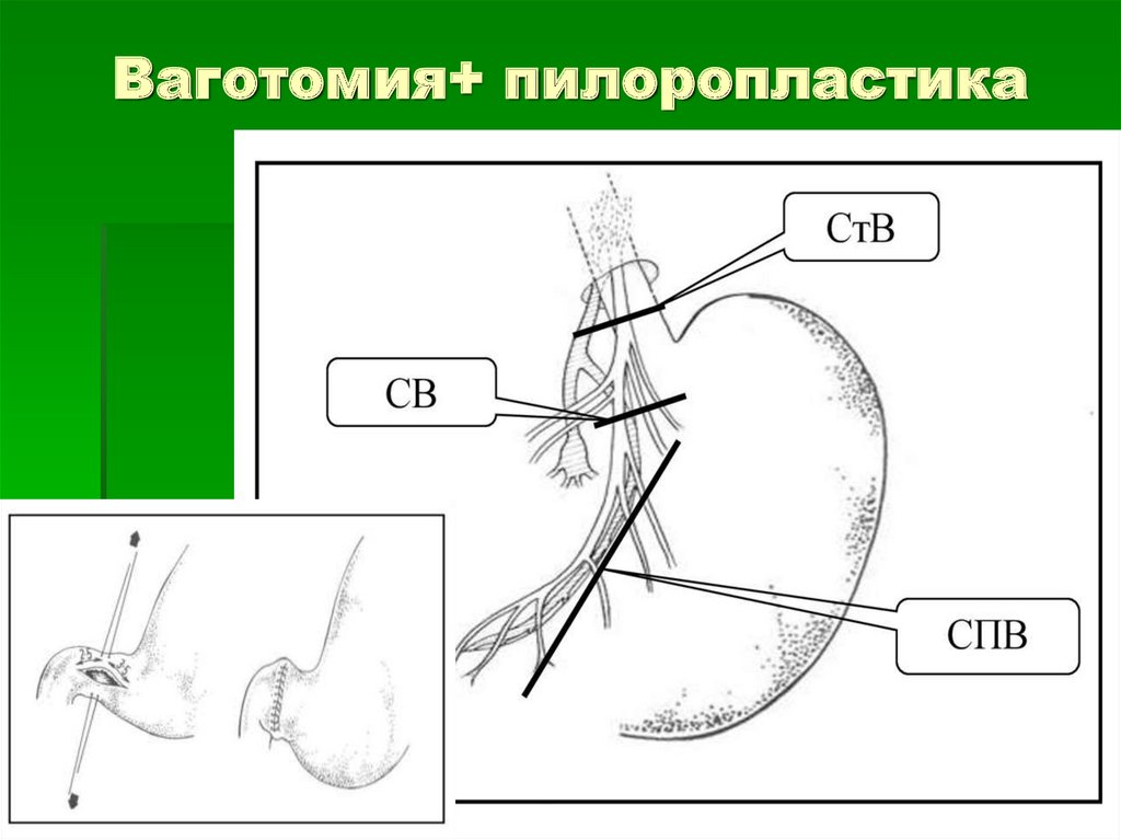 Пилоропластика по финнею схема