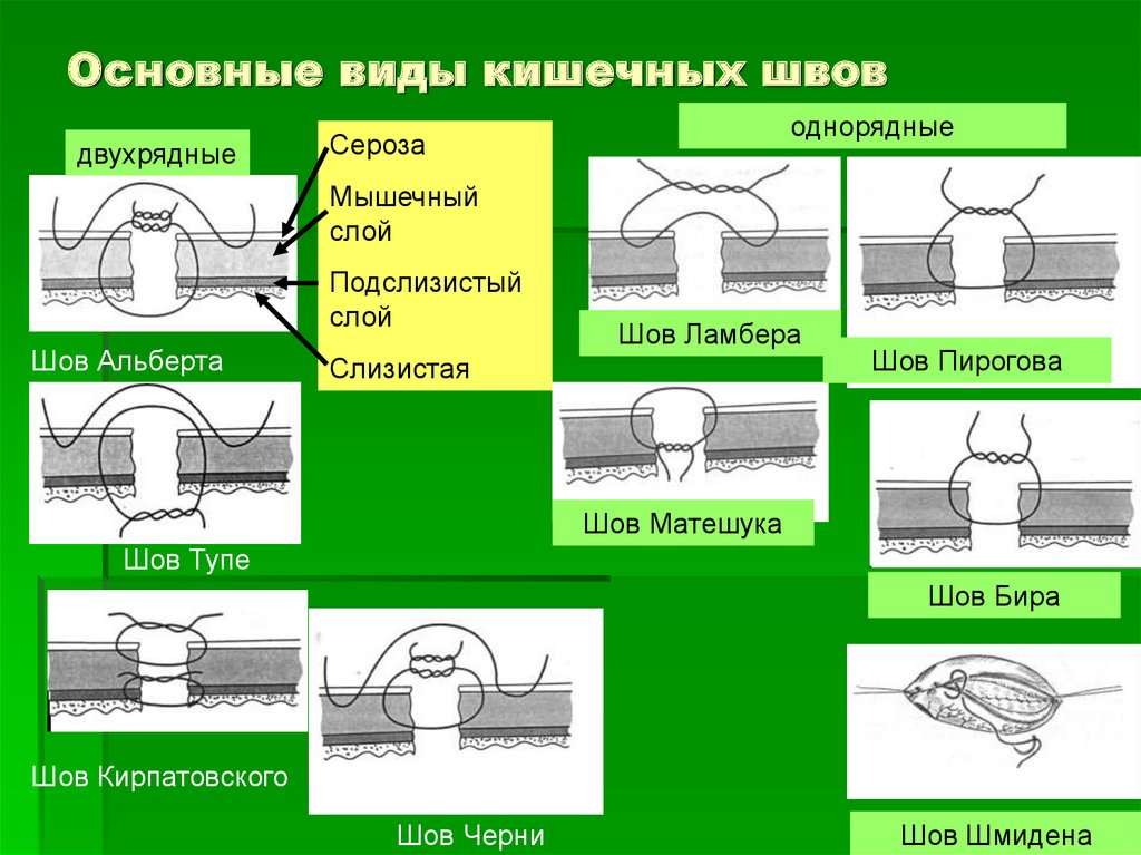 Виды хирургических швов презентация