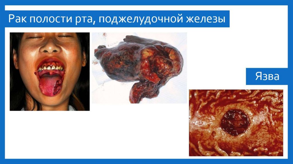 Рак полости рта, поджелудочной железы