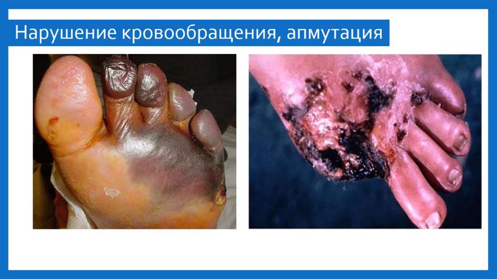 Нарушение кровообращения, апмутация