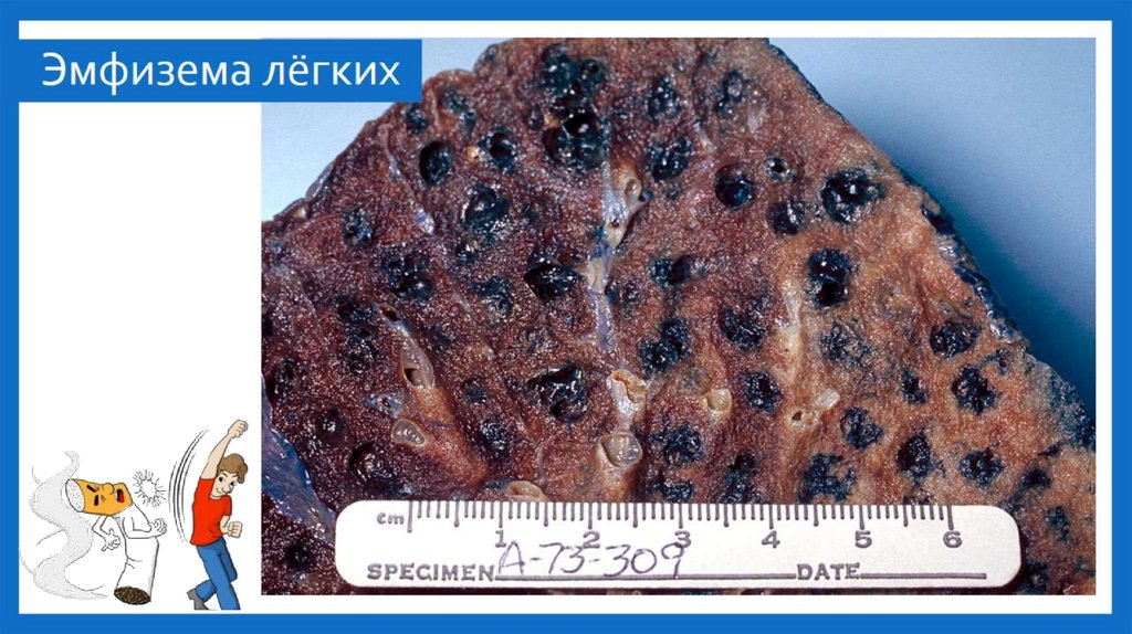 Эмфизема лёгких