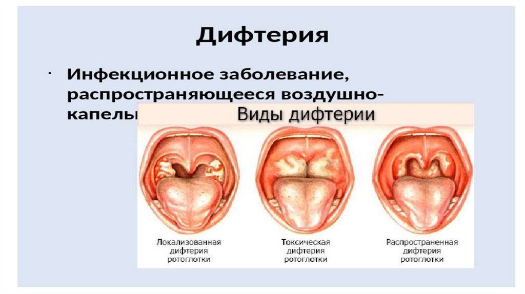 Коклюш паракоклюш презентация