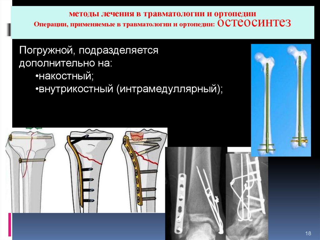 Осложнения остеосинтеза. Остеосинтез костей конечностей. Экстракортикальный остеосинтез. Остеосинтез в травматологии и ортопедии классификация. Цементный остеосинтез кости.