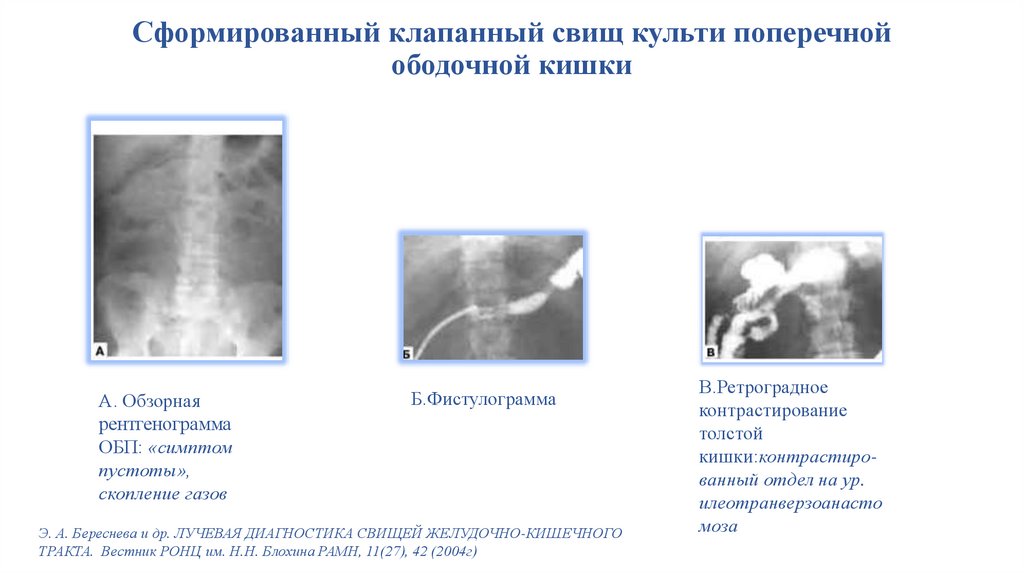 Лечение кишечных свищей