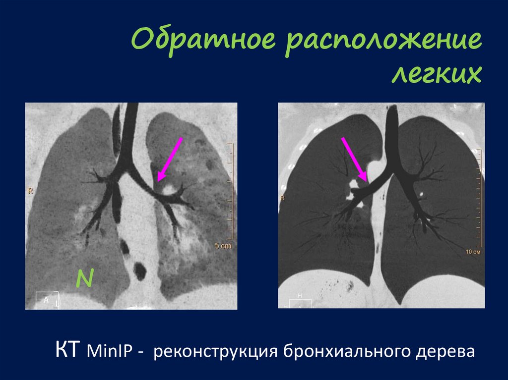 Развитие легких с возрастом