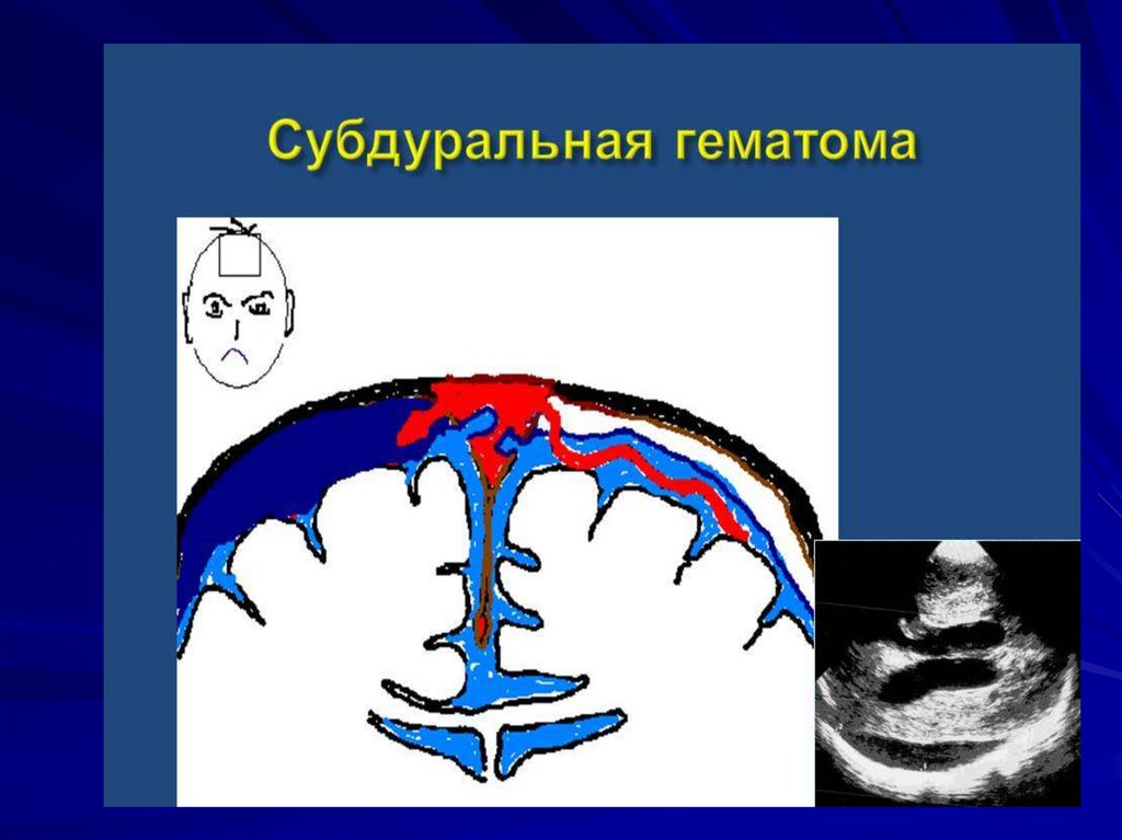 Кровоизлияние у новорожденных