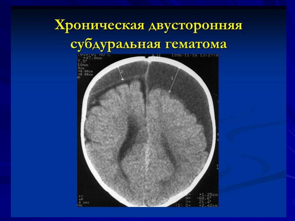 Субдуральная гематома. Хроническая субдуральная гематома. Черепно-мозговая гематома субдуральная. Субдуральная гематома родовая травма. Кт двусторонние субдуральные гематомы.